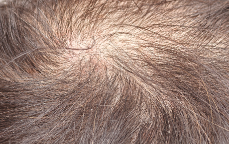 Female Pattern Baldness