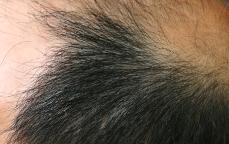 Male Pattern Baldness